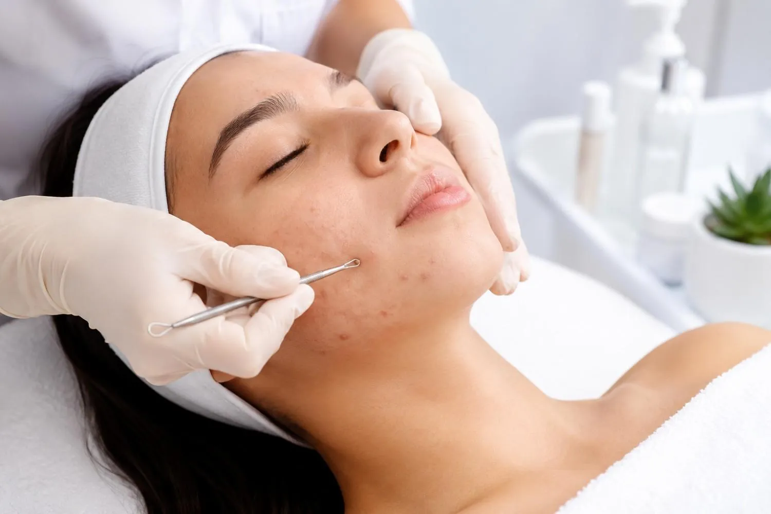 Is Acne Extraction Safe? Risks, Benefits, and What to Expect from Acne Extraction in Singapore
