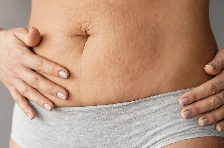 How Many Sessions Are Needed for Stretch Marks Treatment?