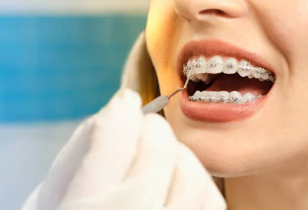 Orthodontist in Arcadia CA: How Expert Orthodontic Care Can Transform Your Smile