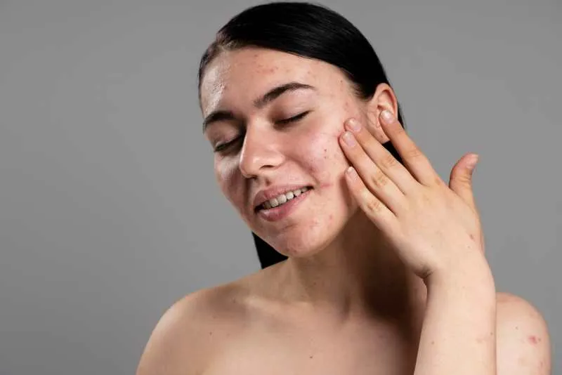 azelaic acid for acne scars