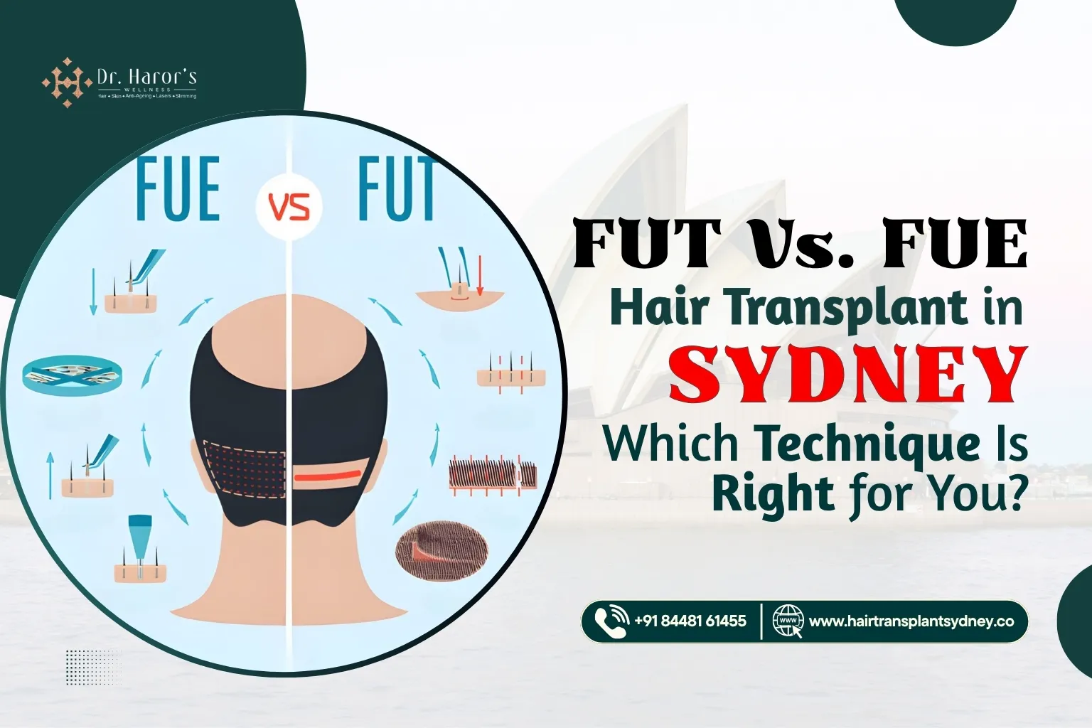 FUT vs FUE Hair Transplant in Sydney: Which One Actually Suits You?