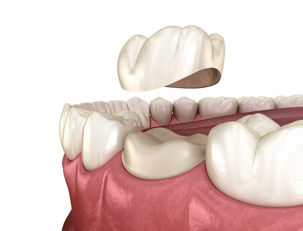 Fillings vs. Crowns: Which Restoration Does Your Tooth Need?