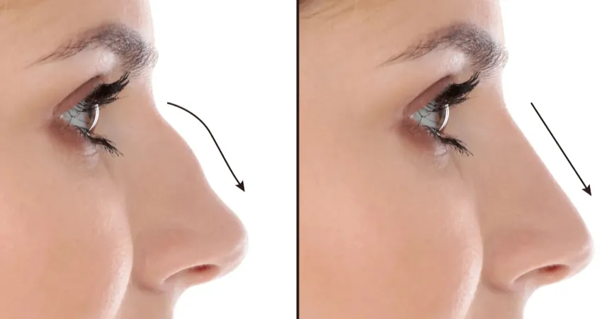 Rhinoplasty in Dubai: Essential Questions to Ask Your Surgeon