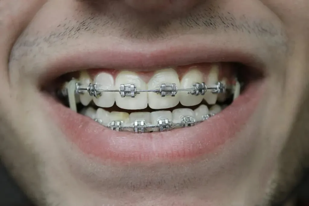 Why Invisible Braces Are Becoming the Preferred Choice for Modern Smiles