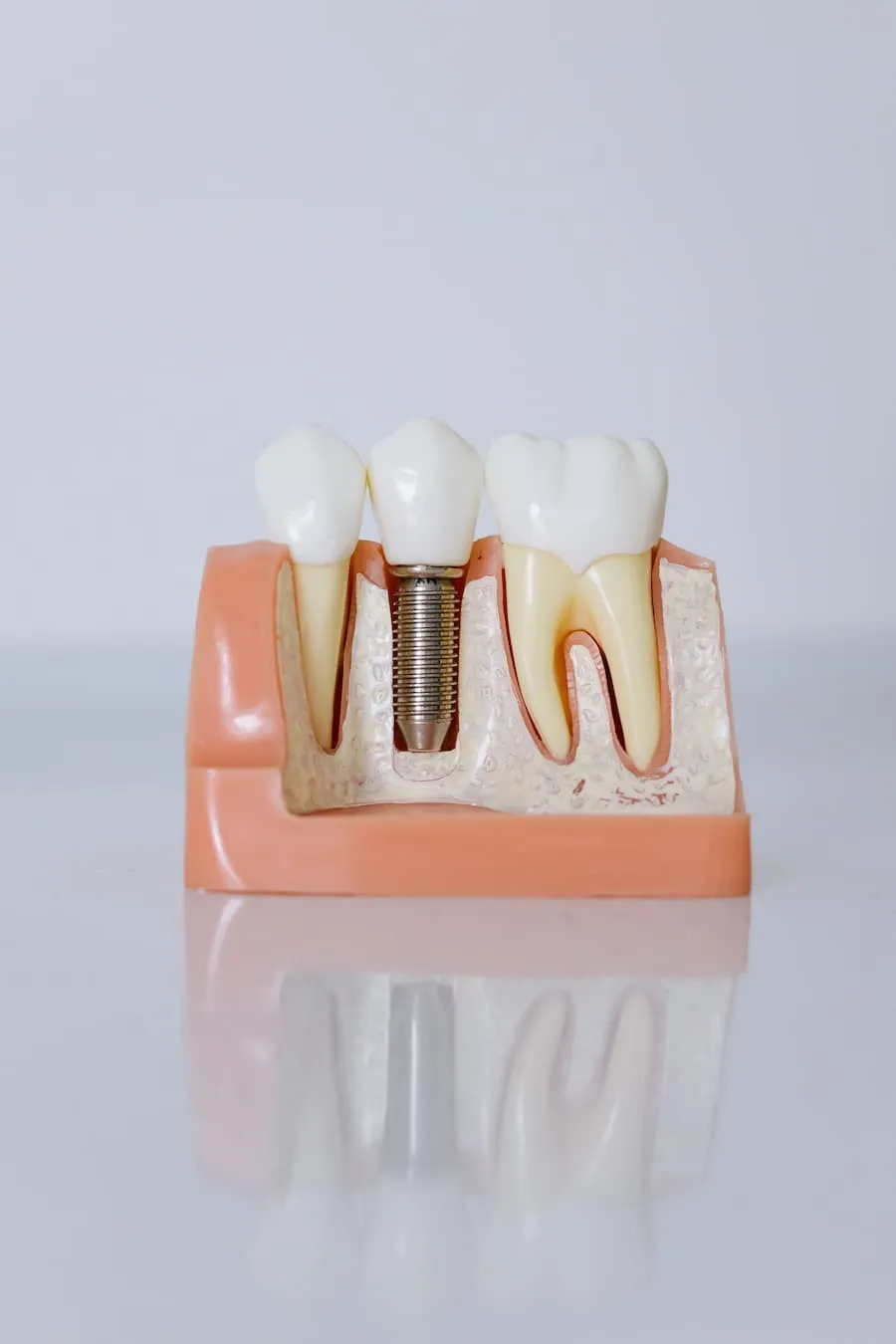 Dental Implants in Scottsdale for Permanent Smile Restoration