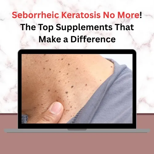 Seborrheic Keratosis No More! The Top Supplements That Make a Difference