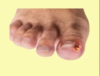 How Podiatrists Remove Ingrown Toenails: What to Expect During Treatment