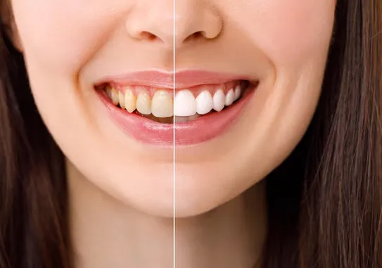 Complete Guide to Zoom Teeth Whitening in Athens AL for a Brighter Smile