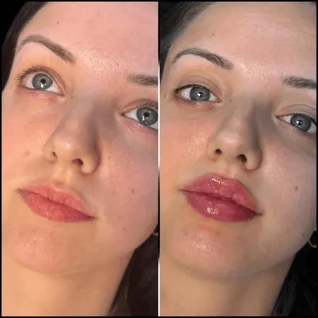 Fillers in Dubai: Customized Facial Rejuvenation