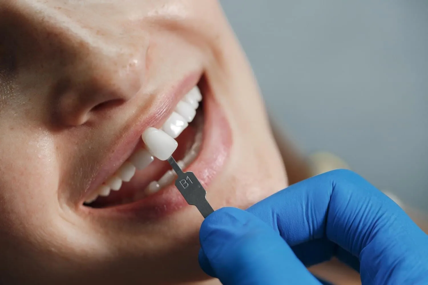 Everything You Need to Know About Veneers for a Confident Smile