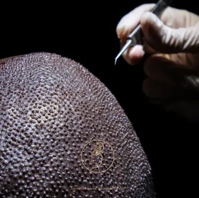 Best Hair Transplant Clinic for HIV Positive Patients: What to Look for Before Choosing a Clinic