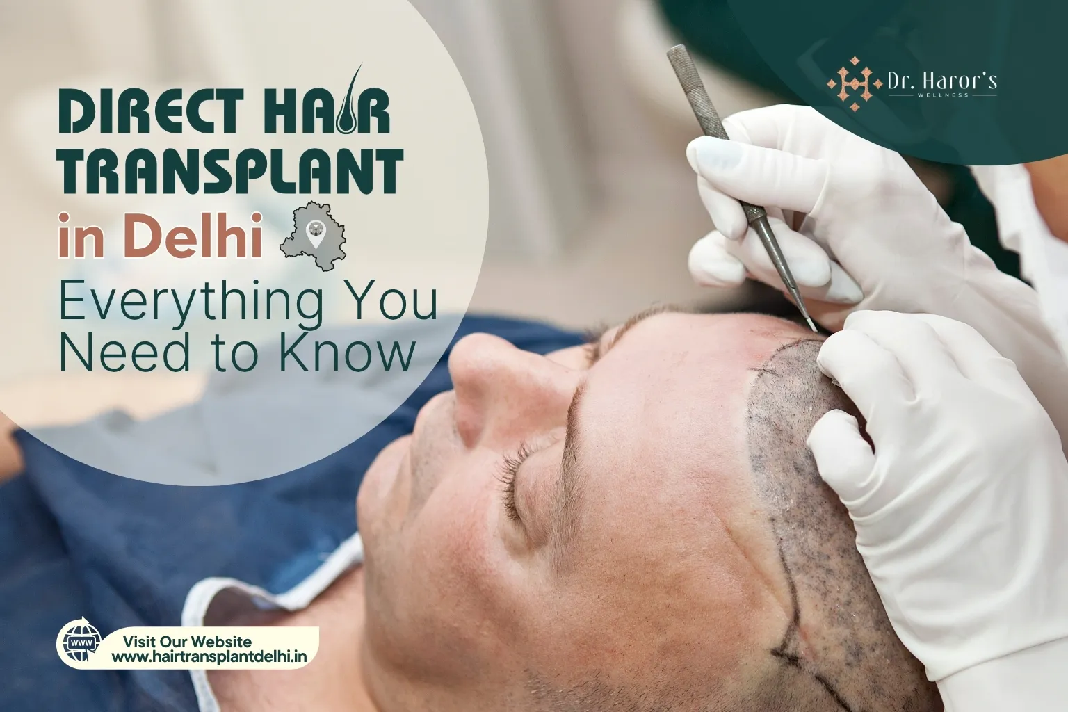 Direct Hair Transplant in Delhi: Everything You Need to Know
