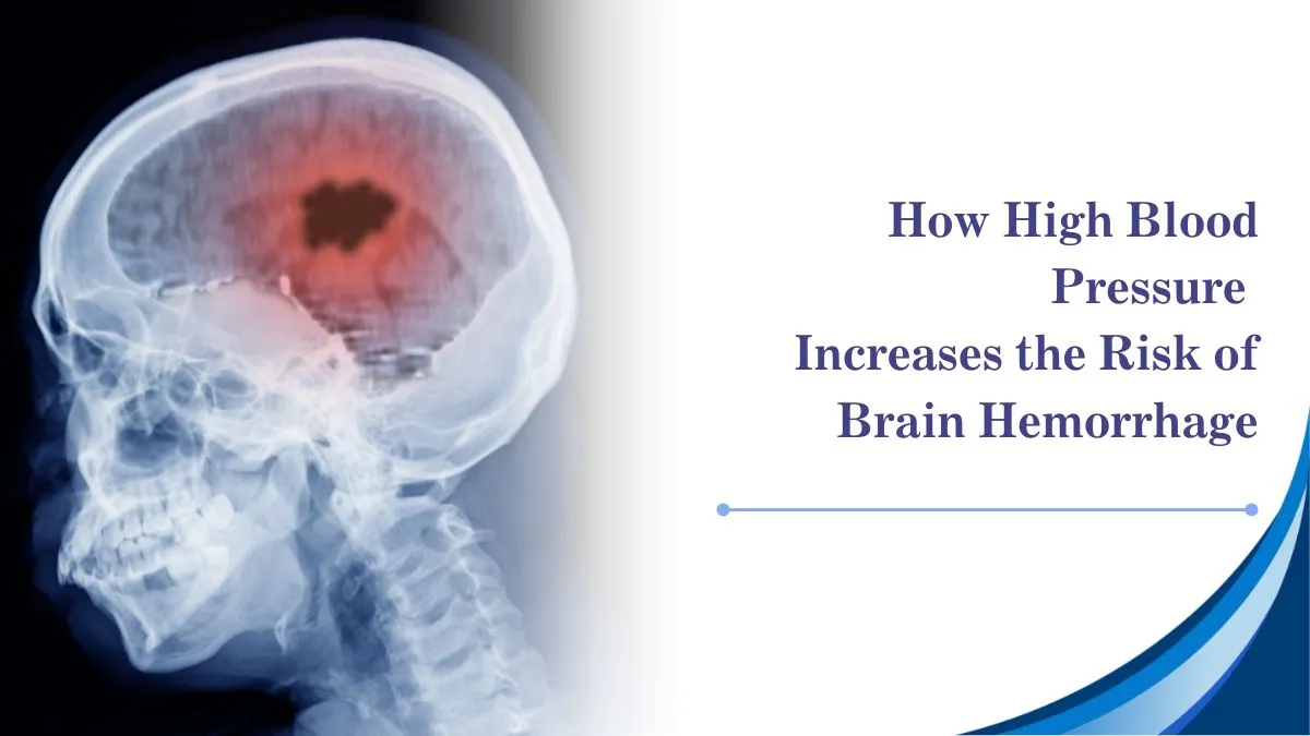 How High Blood Pressure Increases the Risk of Brain Hemorrhage