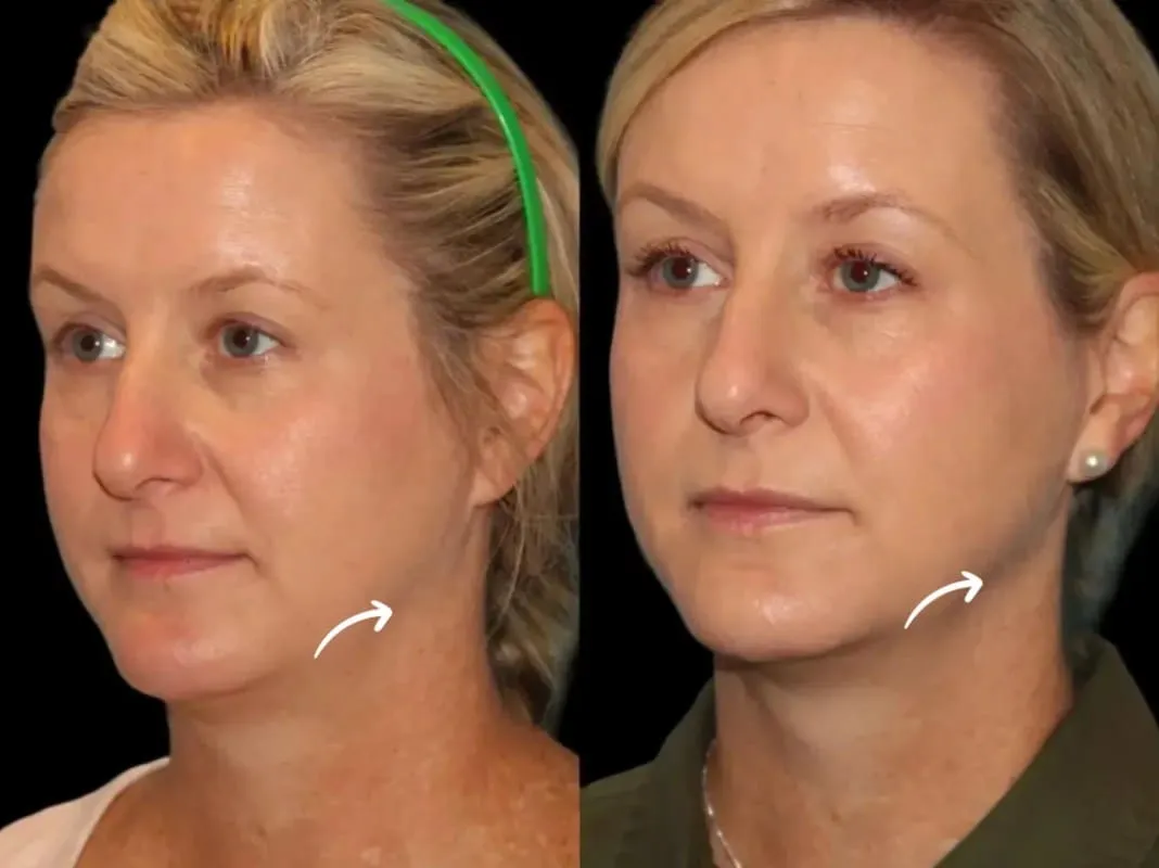 Best Plastic Surgeon in Dubai for Sculptra Face Shape
