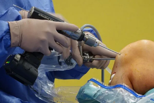 Minimally Invasive Bunion Surgery: Everything You Need to Know