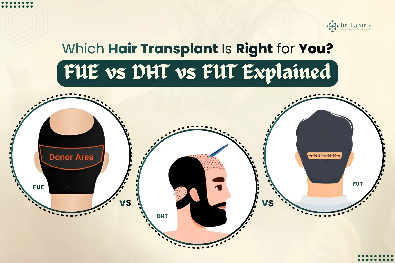 Which Hair Transplant Is Right for You? FUE vs DHT vs FUT Explained