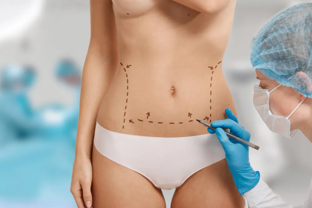 Is Liposuction Permanent? Everything You Need to Know