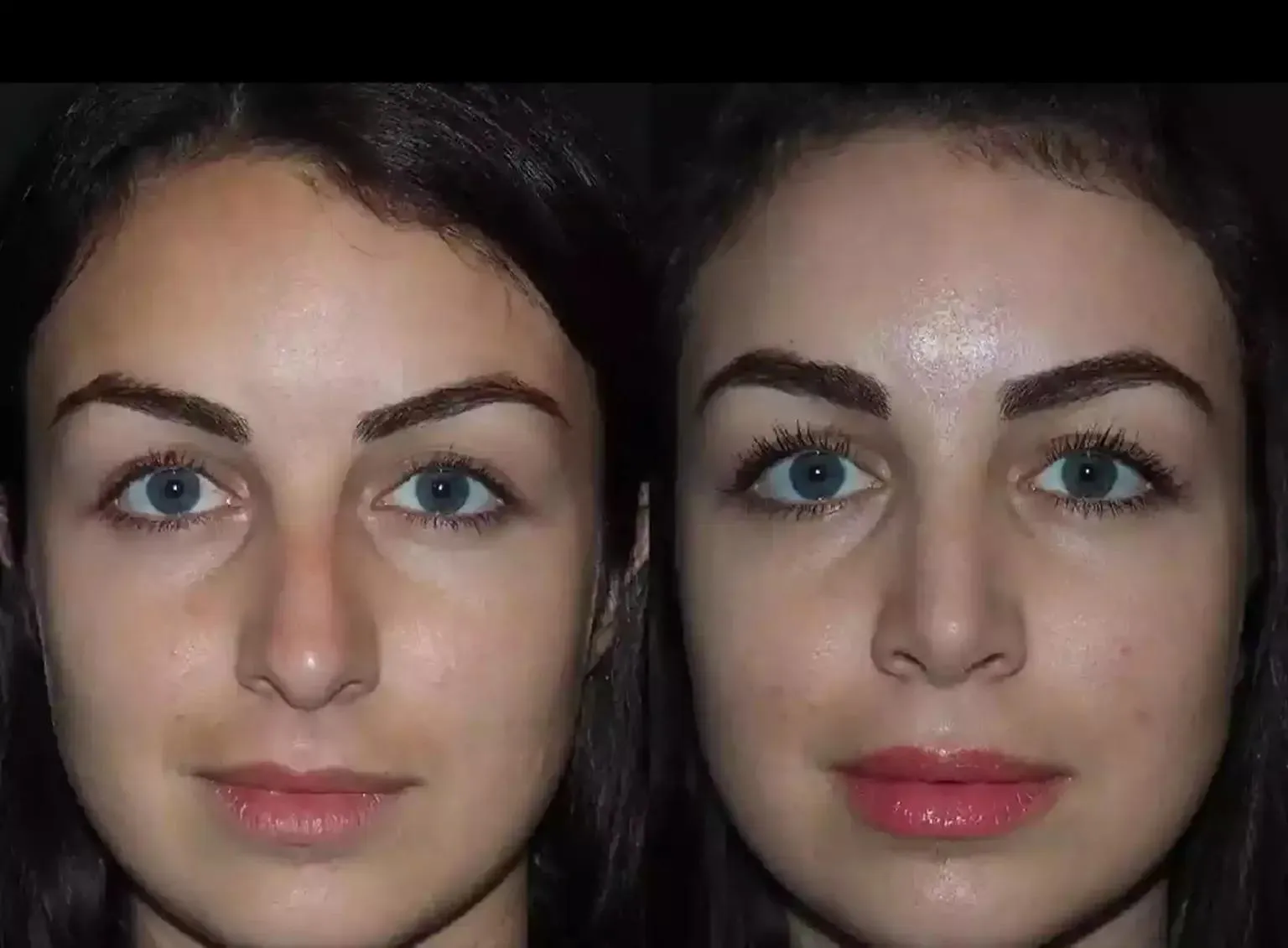 How Does Septoplasty in Dubai Address Structural Nasal Problems?