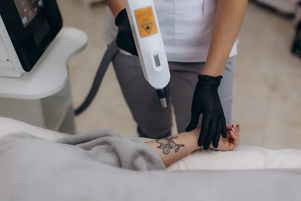 Tattoo Removal Manchester Everything You Need to Know