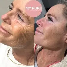 Anti Wrinkle Injections in London: Combining Safety, Precision and Natural Beauty