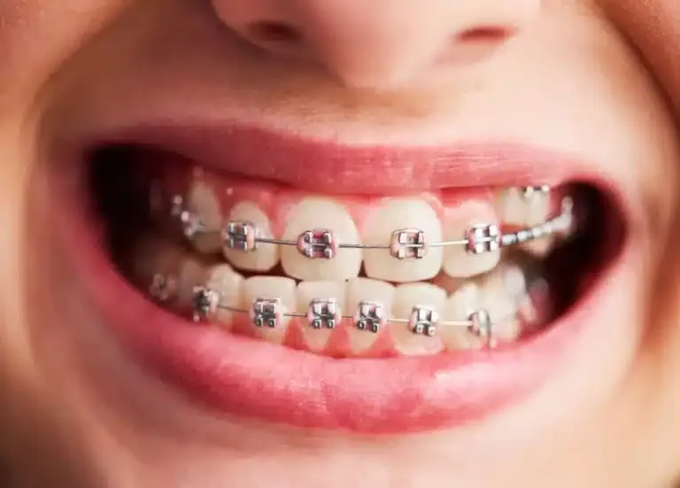 Invisible Aligners vs Traditional Braces: Which Is Right for You?