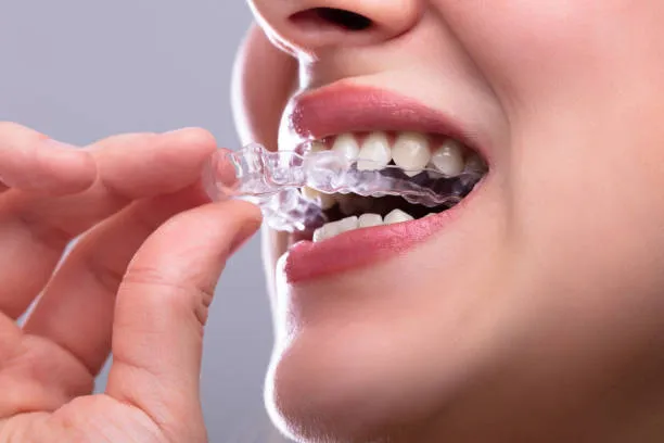 A Modern Guide to Clear Smile Transformation: What You Should Know Before Choosing Invisalign