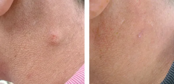 Benefits of Choosing Expert Pilar Cyst Removal