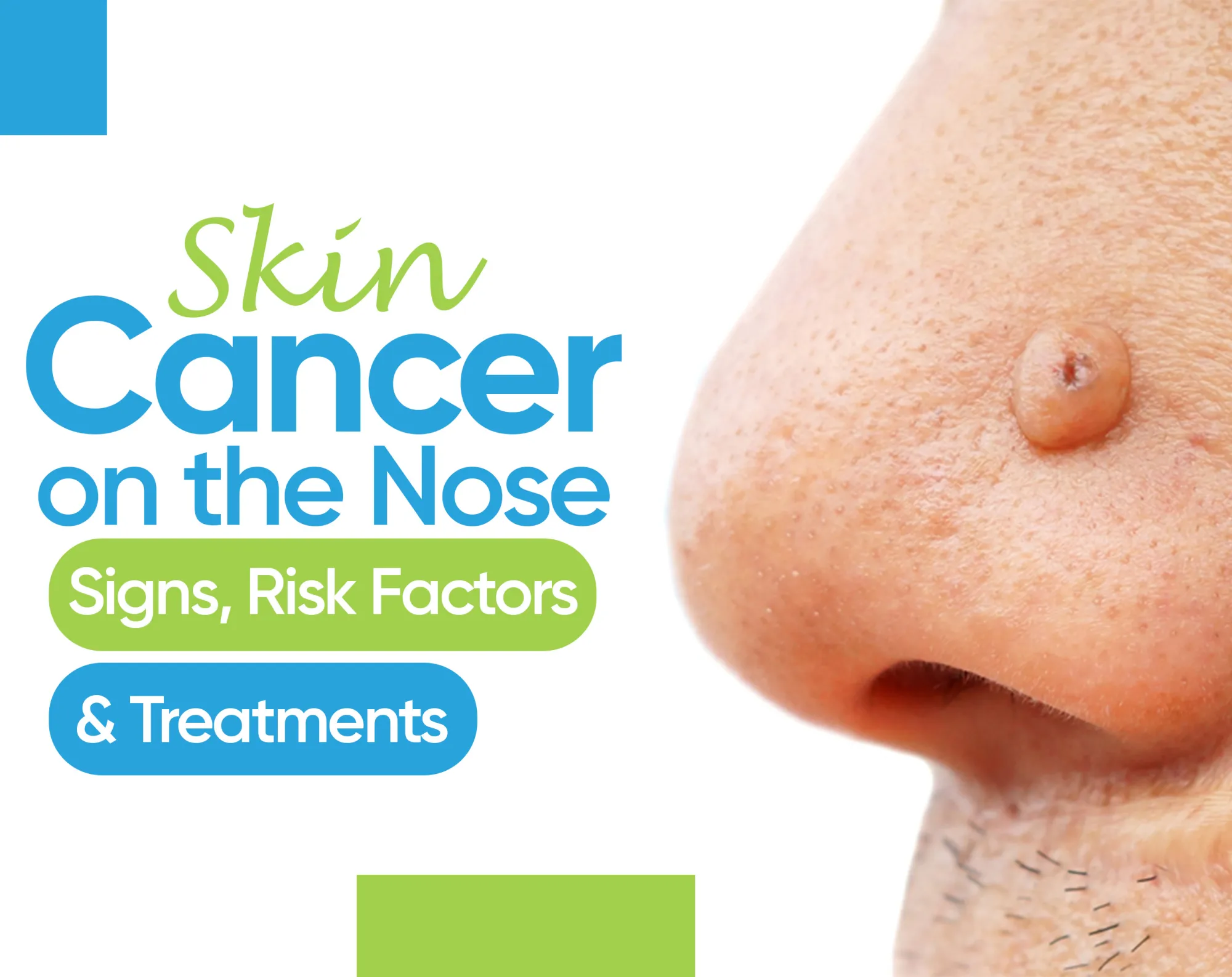 Signs and Symptoms of Skin Cancer on Nose