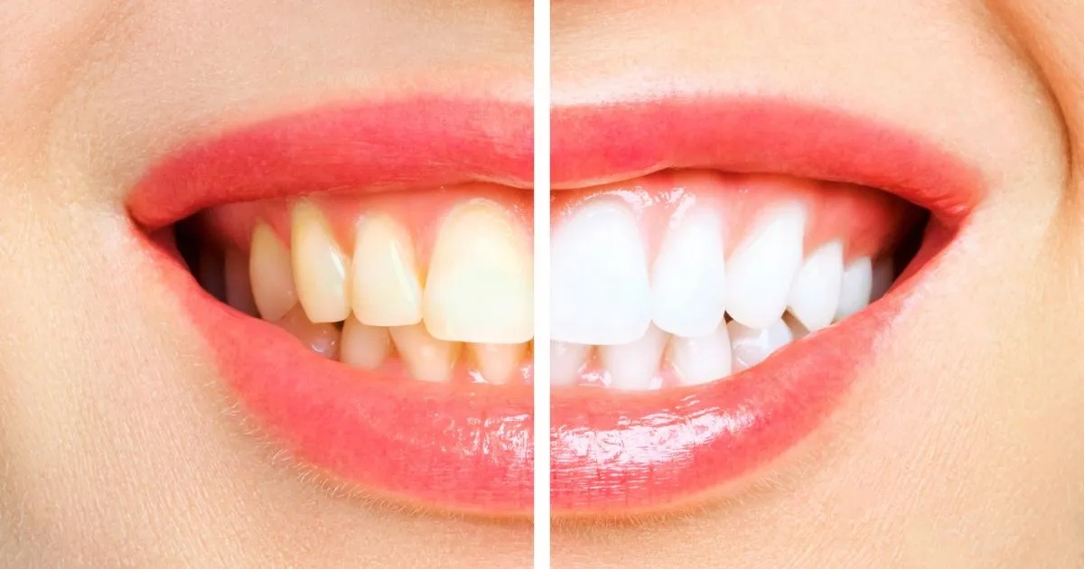 Teeth Scaling in Lahore | Professional Dental Cleaning for Healthy Gums