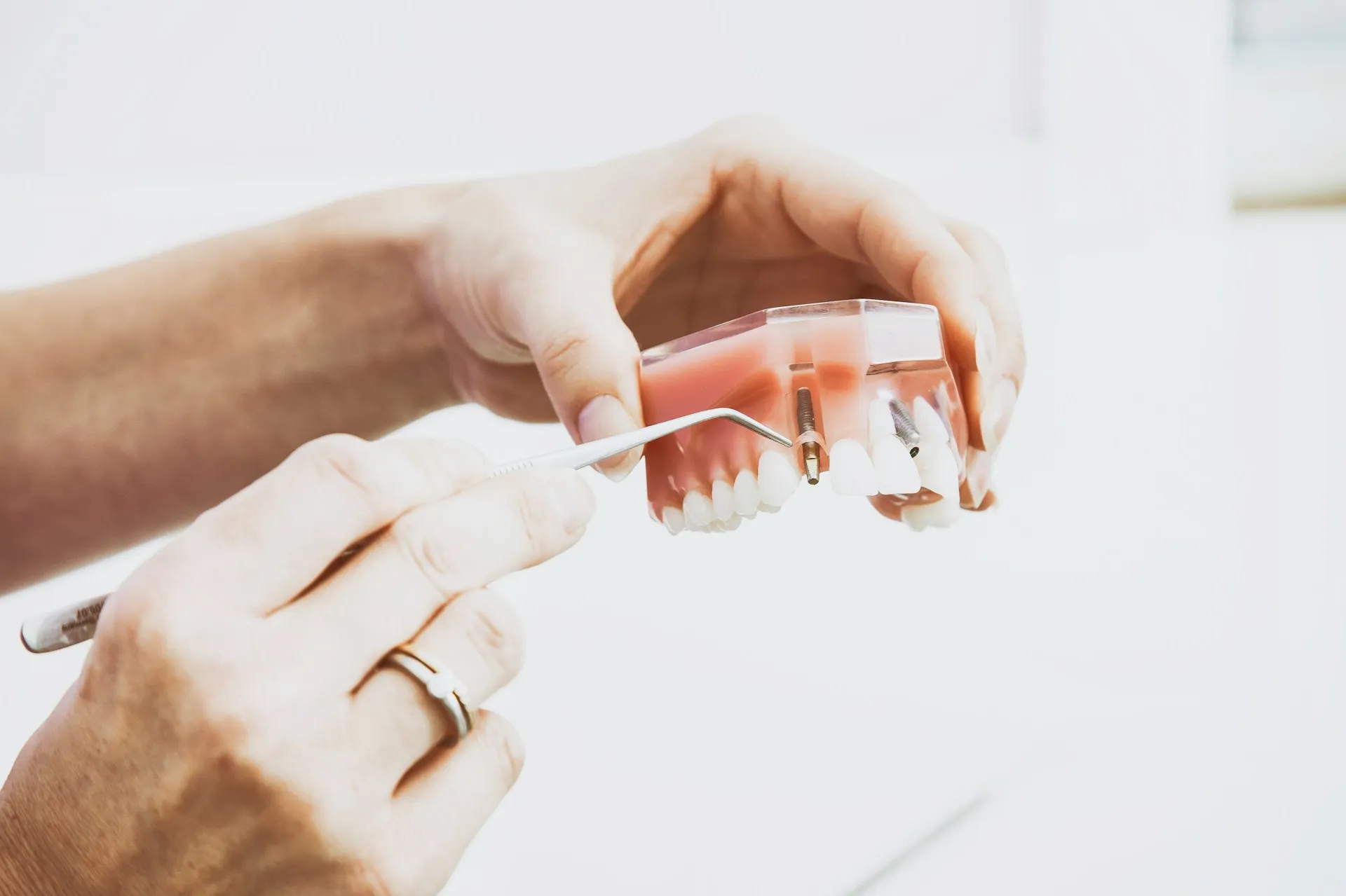 What Makes Dental Implants the Gold Standard for Tooth Replacement