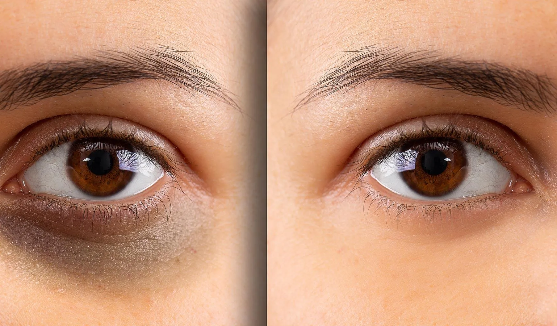 Under Eye Pigmentation