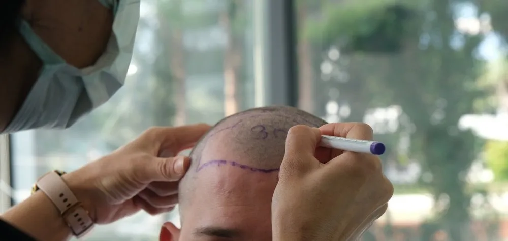Everything You Should Know Before Hair Transplant Surgery