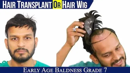 Hair Weaving vs Hair Transplant