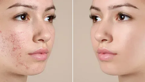 Pimple treatment in Dubai: Clear Skin Guide