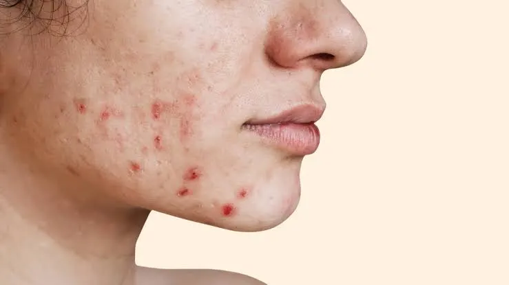 Facial Acne Breakouts: Main Causes and Laser Treatment