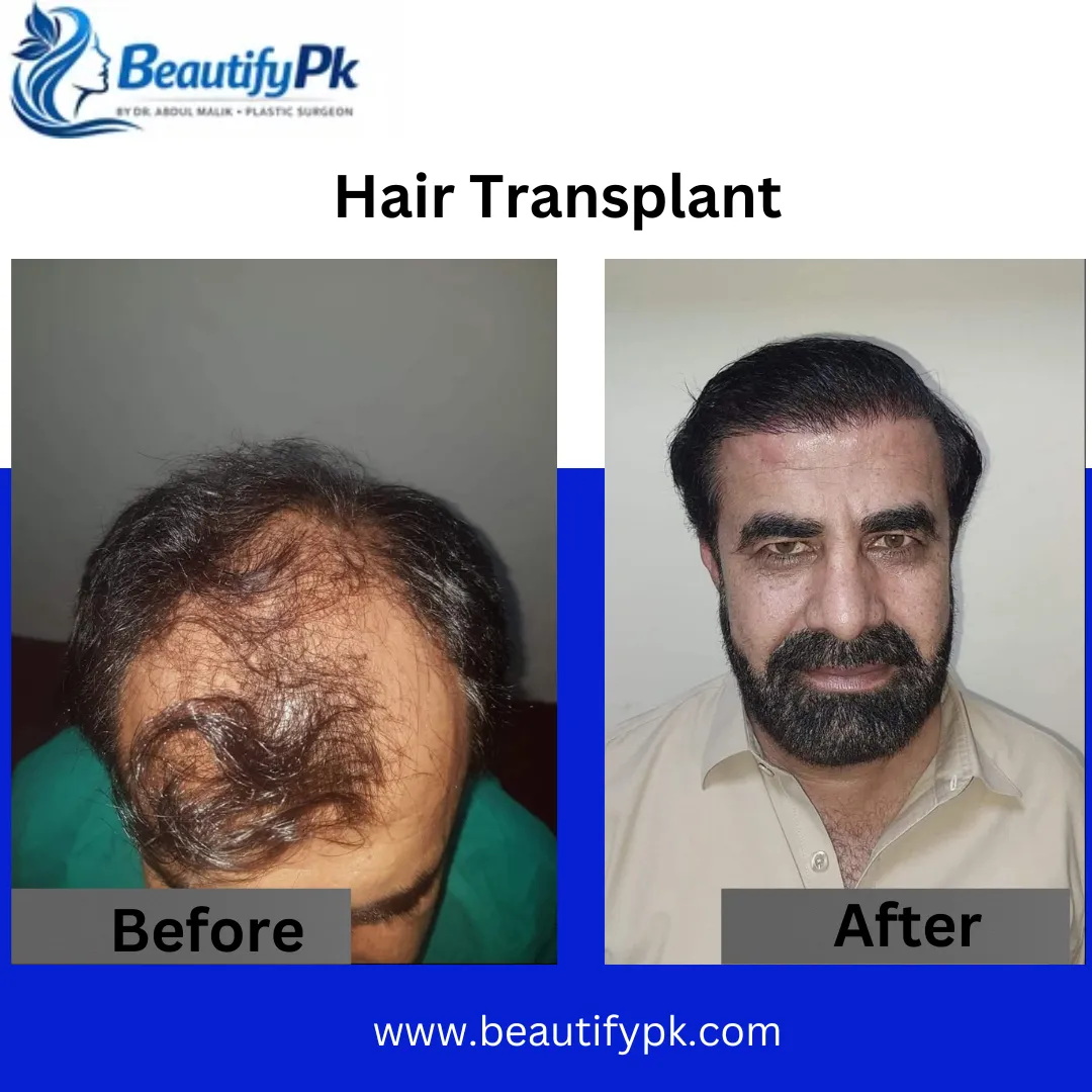 Hair Transplant Surgery Explained: Procedure, Benefits & What to Expect