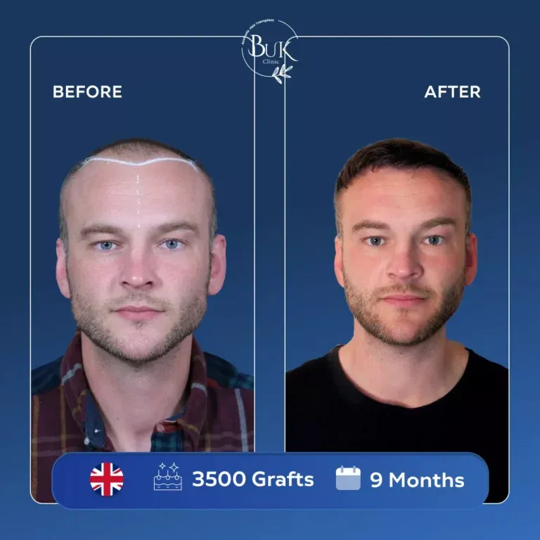 Unshaven Hair Implant Turkey: A Complete Guide to Natural Hair Restoration Without Shaving