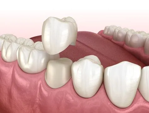 Affordable Dental Crown Cost in Zirakpur: How to Choose the Right Crown