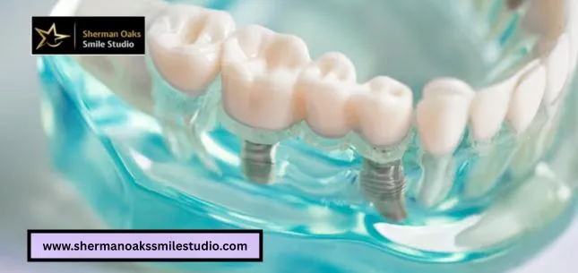Dental Bridge Cost What You Should Expect to Pay