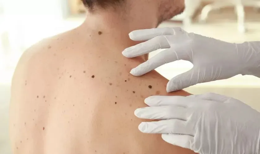 Cryotherapy in Melbourne: Professional Mole Map and Mole Removal Services