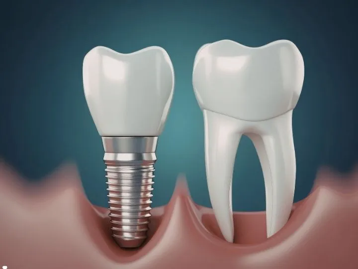 Are Dental Implants Worth It? Pros, Costs and Recovery