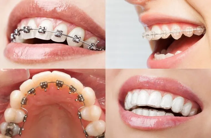 Teeth Braces in India: What to Expect, How to Prepare, and Why It's Worth It