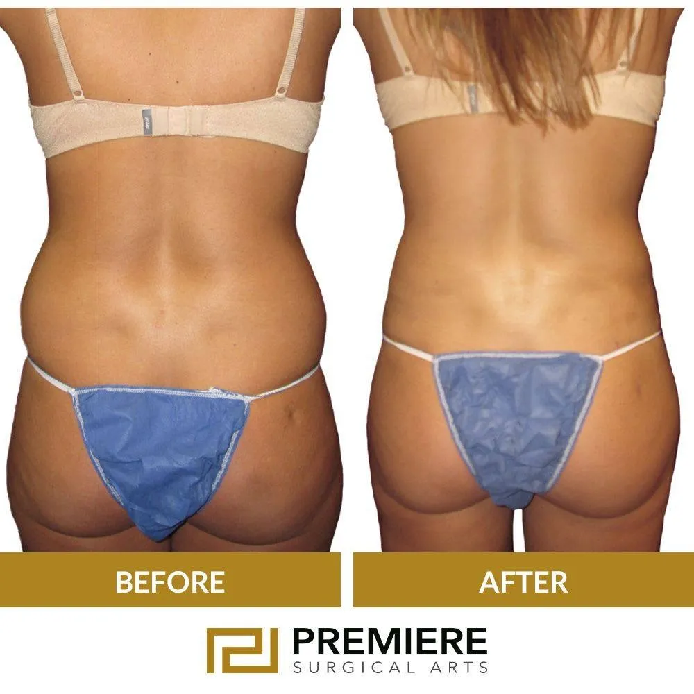 What Should You Do Before and After Vaser Liposuction?