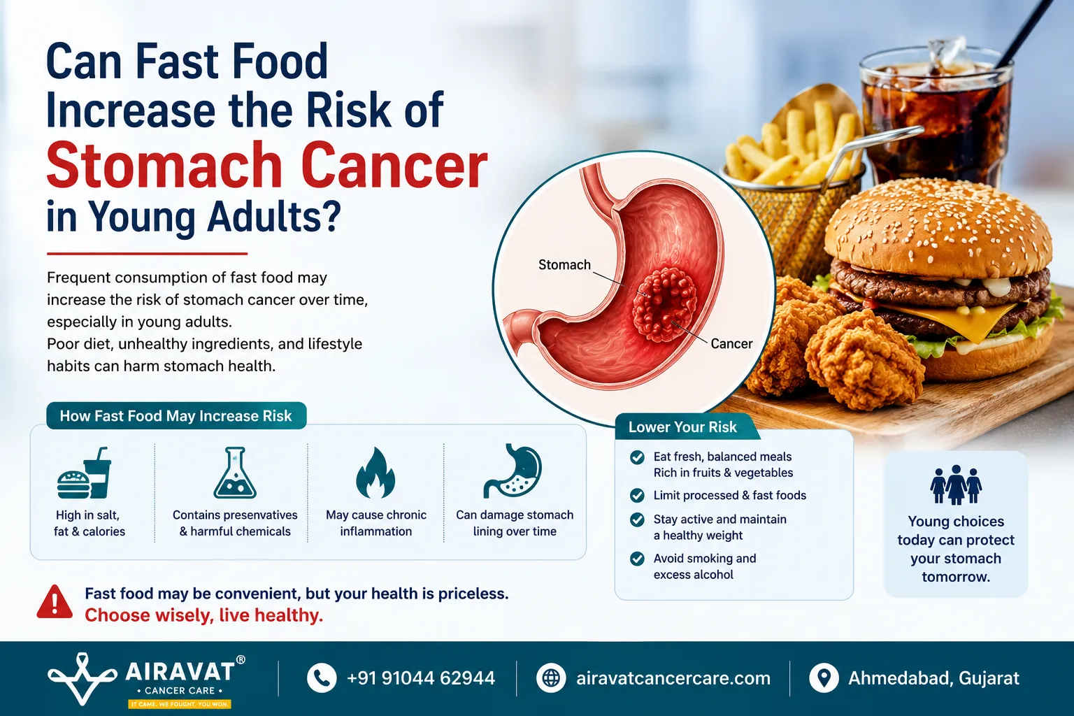 Can Fast Food Increase the Risk of Stomach Cancer in Young Adults?
