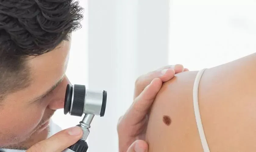 When Should You Consider Mole Removal? Warning Signs Worth Paying Attention To