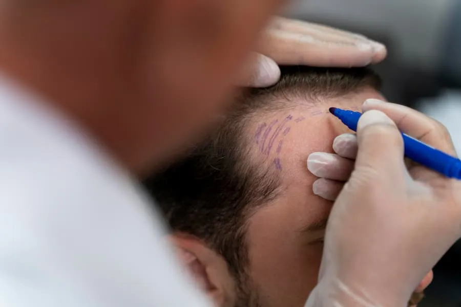 A Complete Guide to Hair Transplant Procedures and Expected Results