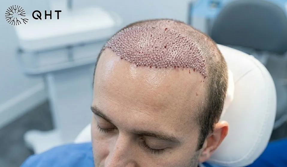 Hair Transplant Cost in Jaipur: A Complete Guide to Pricing Factors in 2026