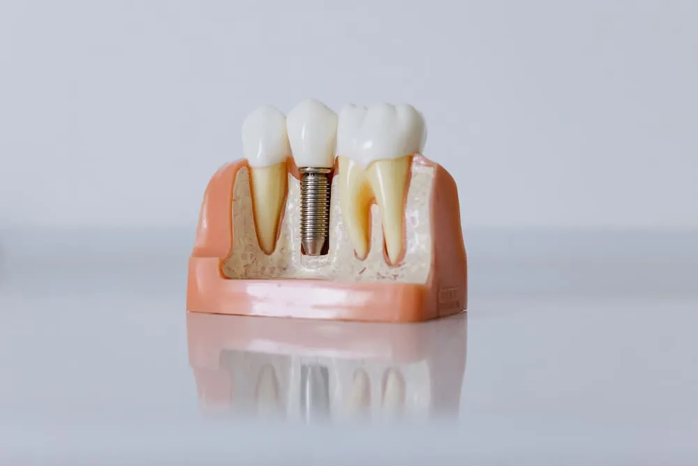 How to Care for Dental Implants in Essex UK