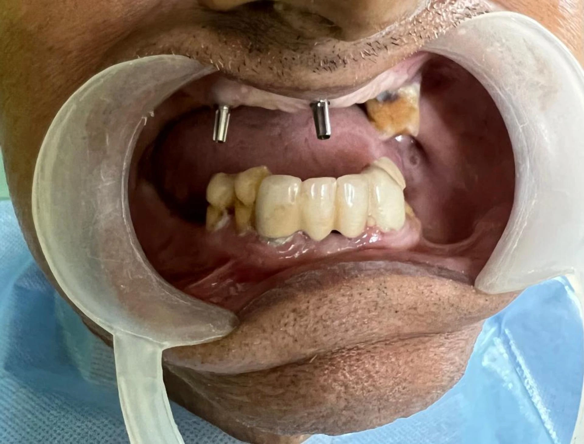 Why do people get dental implants?