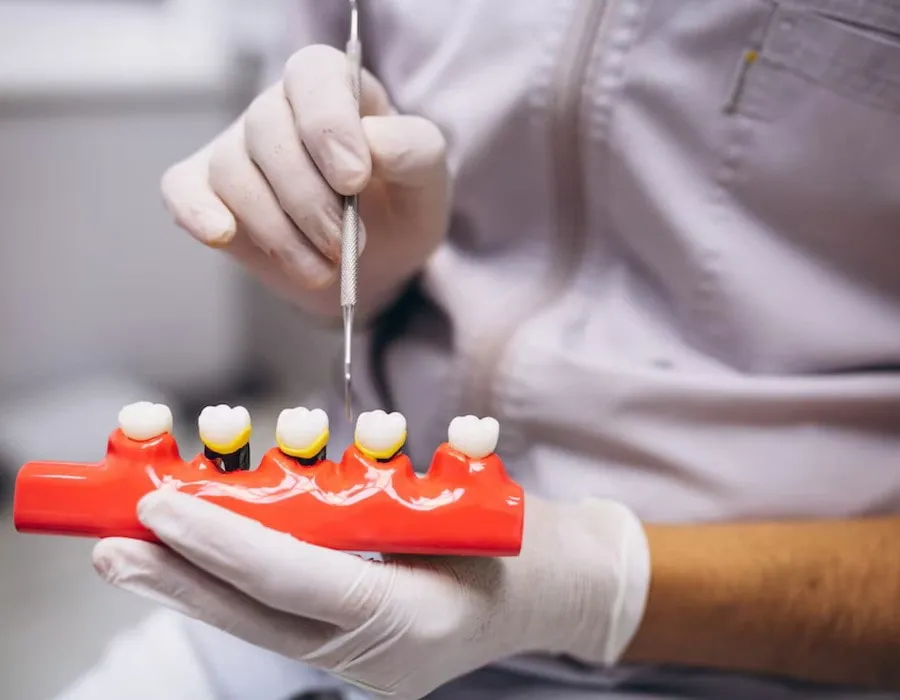 Dental Implants: A Complete Guide to Restoring Missing Teeth